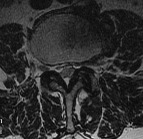 Lumbar stenosis axial MRI